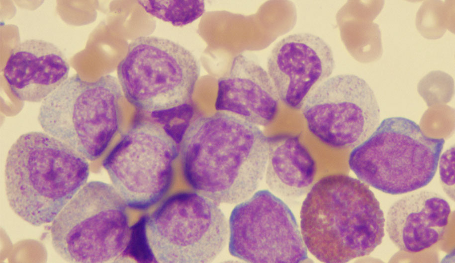 chronic myeloid leukemia |لوسمی میلوئید مزمن یا CML چیست؟