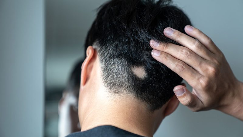 آلوپسی آره‌آتا